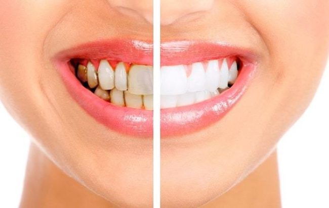 Are Crest Whitening Strips Safe